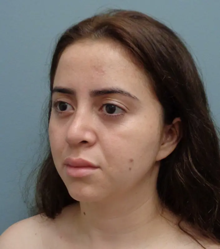 Rhinoplasty Before & After Pictures in Nashville, TN