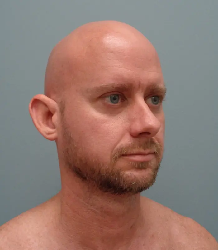 Otoplasty Before & After Pictures in Nashville, TN
