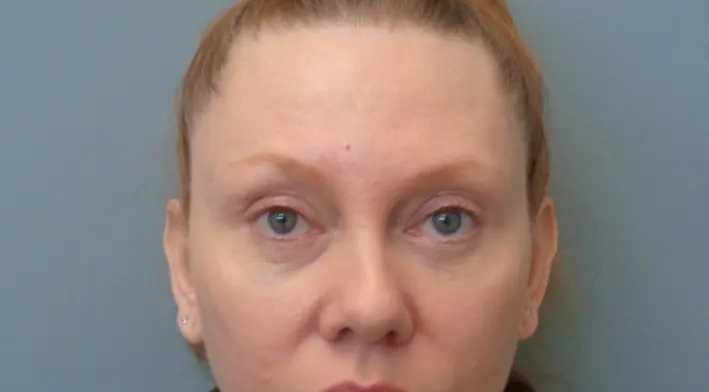 Blepharoplasty Before & After Pictures in Nashville, TN