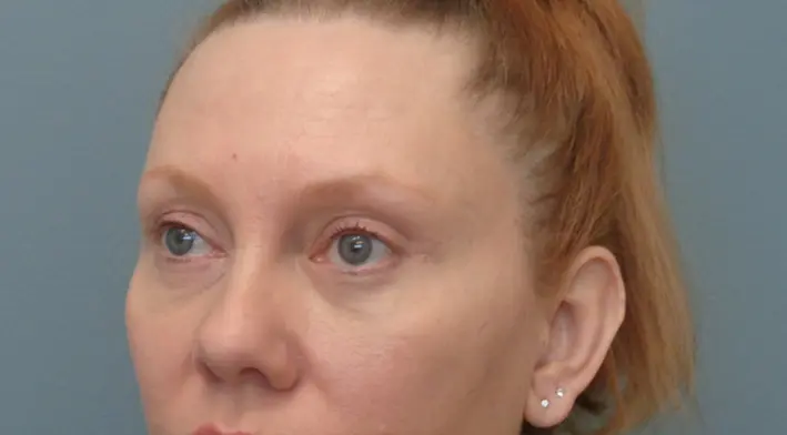 Blepharoplasty Before & After Pictures in Nashville, TN