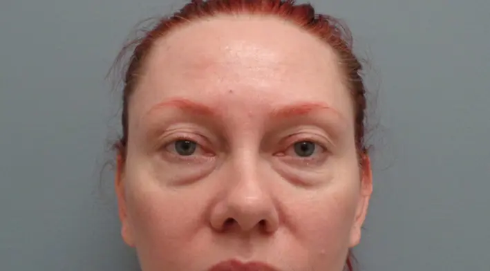 Blepharoplasty Before & After Pictures in Nashville, TN