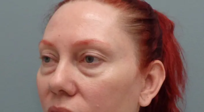 Blepharoplasty Before & After Pictures in Nashville, TN