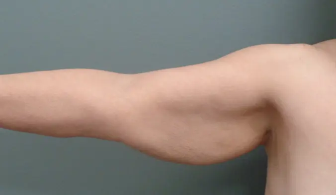 Arm Lift Before & After Pictures in Nashville, TN