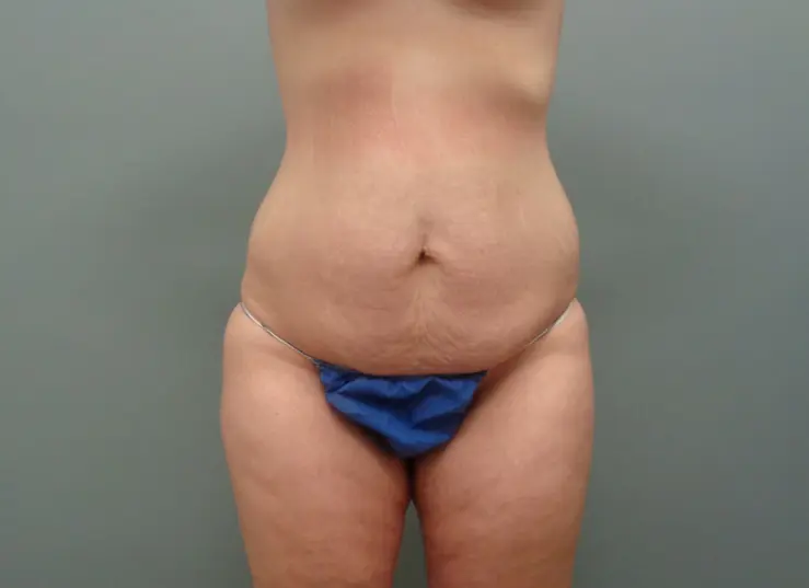 Body Lift Before & After Pictures in Nashville, TN