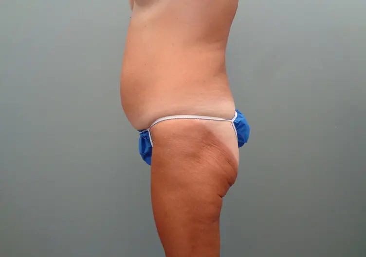 Mommy Makeover Before & After Pictures in Nashville, TN