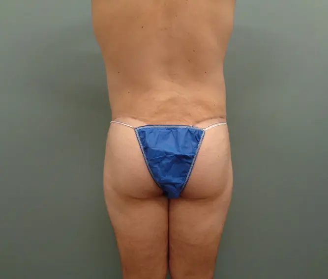 Body Lift Before & After Pictures in Nashville, TN