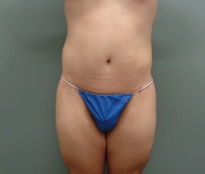 Body Lift Before & After Pictures in Nashville, TN