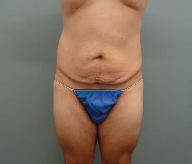 Body Lift Before & After Pictures in Nashville, TN