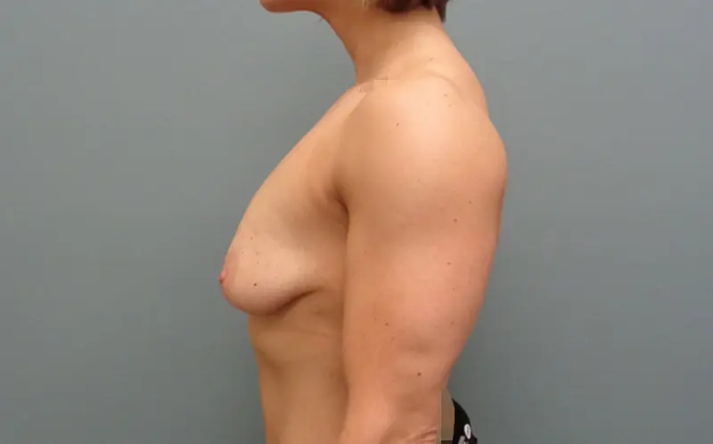 Breast Augmentation with Lift Before & After Pictures in Nashville, TN
