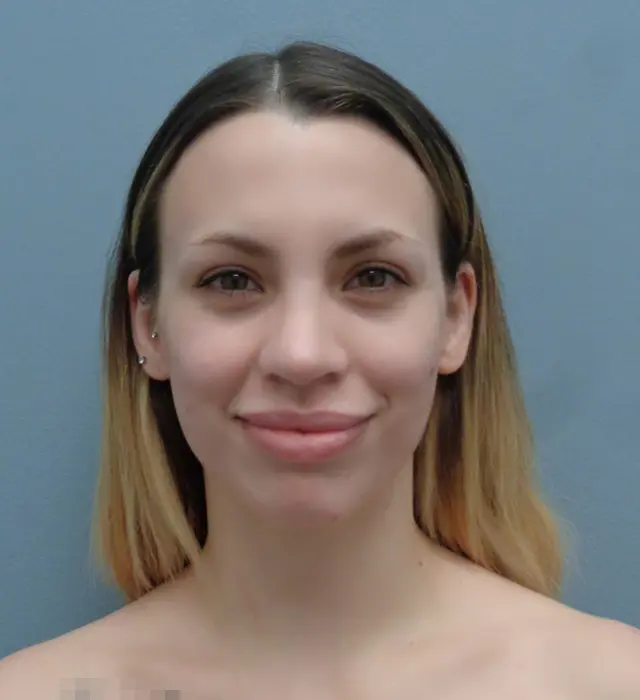 Rhinoplasty Before & After Pictures in Nashville, TN