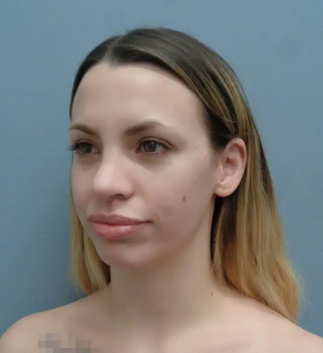 Rhinoplasty Before & After Pictures in Nashville, TN