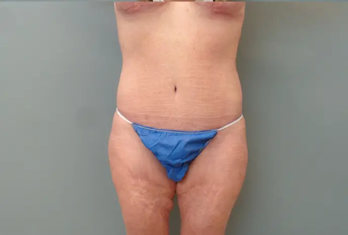 Mommy Makeover Before & After Pictures in Nashville, TN