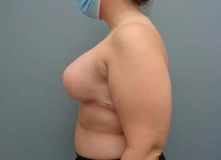 Implant Exchange Before and After Pictures in Nashville, TN