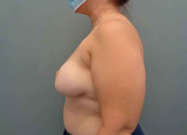 Implant Exchange Before and After Pictures in Nashville, TN