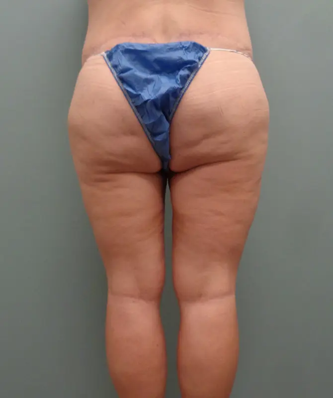 Thigh Lift Before and After Pictures in Nashville, TN