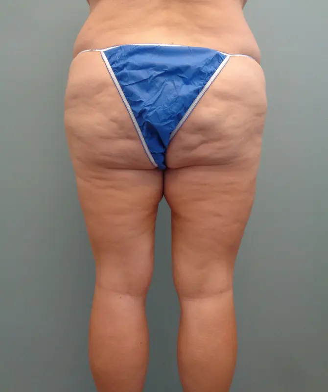 Thigh Lift Before and After Pictures in Nashville, TN