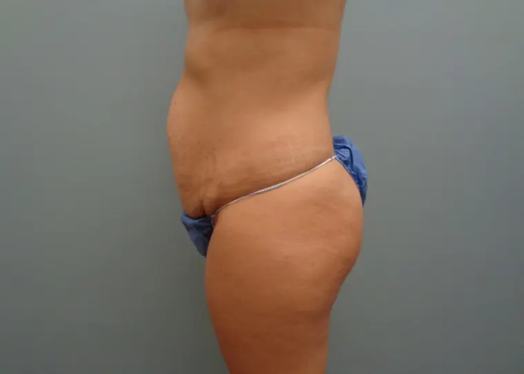 Tummy Tuck Before and After Pictures in Nashville, TN