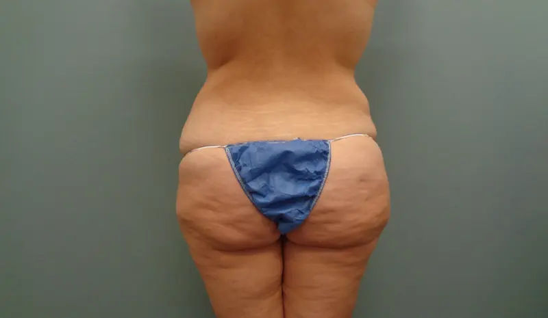 BODY LIFT BEFORE & AFTER PICTURES IN NASHVILLE, TN