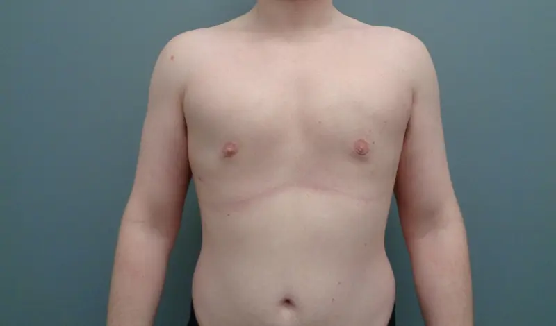 GYNECOMASTIA BEFORE & AFTER PICTURES IN NASHVILLE, TN