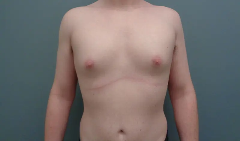 GYNECOMASTIA BEFORE & AFTER PICTURES IN NASHVILLE, TN