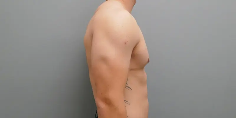 Gynecomastia Before & After Pictures in Nashville, TN