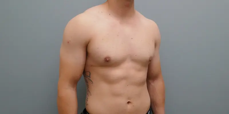 Gynecomastia Before & After Pictures in Nashville, TN