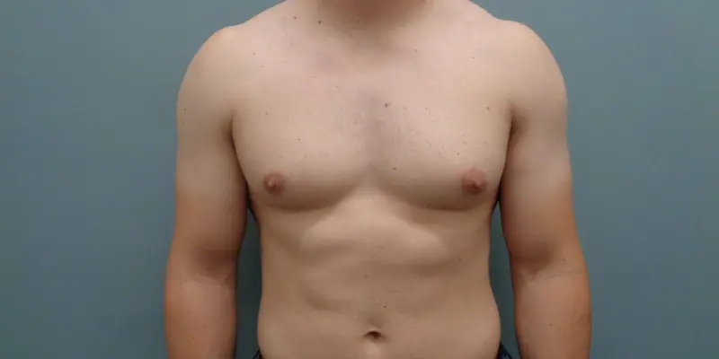 Gynecomastia Before & After Pictures in Nashville, TN