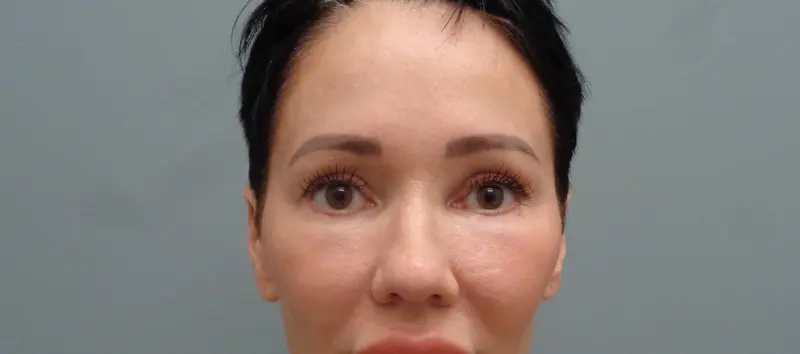 BLEPHAROPLASTY BEFORE & AFTER PICTURES IN NASHVILLE, TN