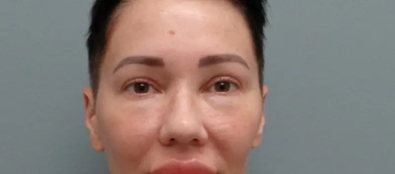BLEPHAROPLASTY BEFORE & AFTER PICTURES IN NASHVILLE, TN