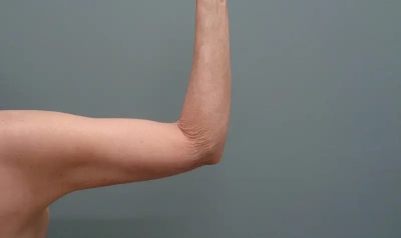 Arm Lift Before and After Pictures Nashville, TN