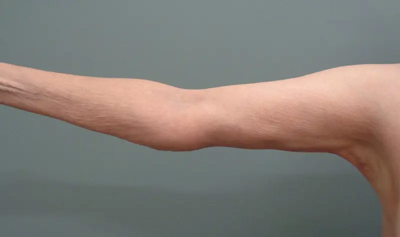 Arm Lift Before and After Pictures Nashville, TN