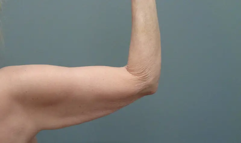 Arm Lift Before and After Pictures Nashville, TN