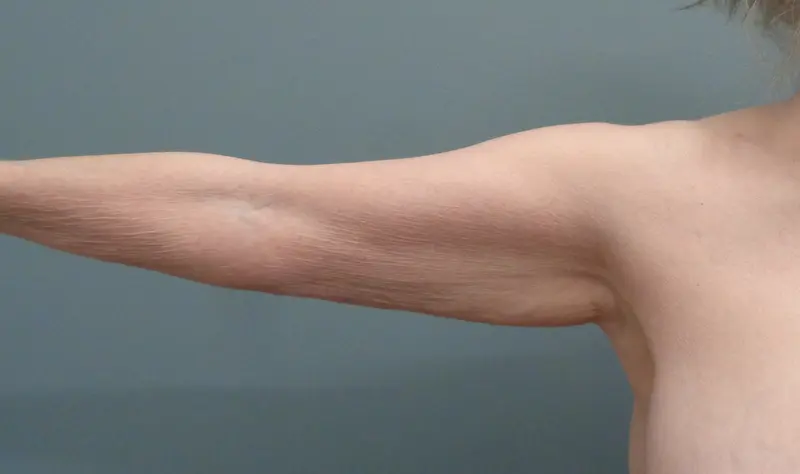 Arm Lift Before and After Pictures Nashville, TN