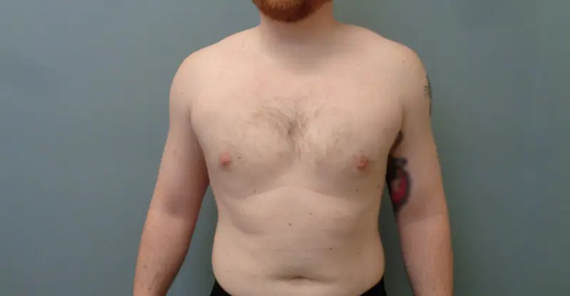 Gynecomastia Before & After Pictures in Nashville, TN