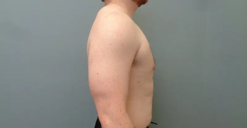 Gynecomastia Before & After Pictures in Nashville, TN