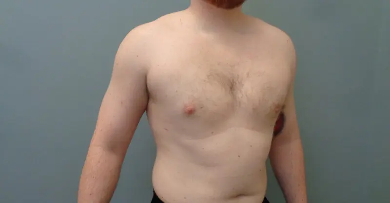 Gynecomastia Before & After Pictures in Nashville, TN