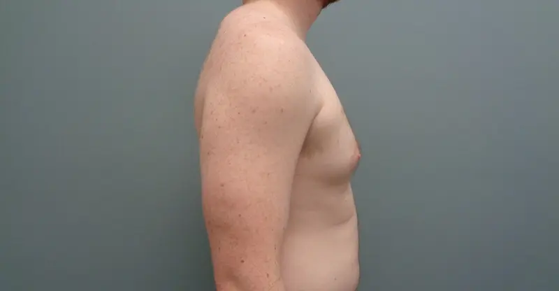 Gynecomastia Before & After Pictures in Nashville, TN