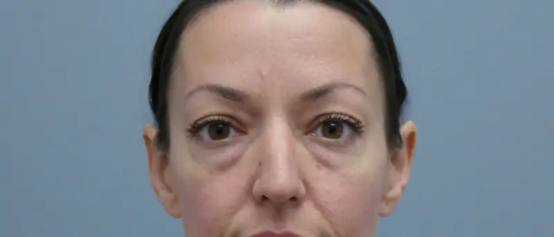 BLEPHAROPLASTY BEFORE & AFTER PICTURES IN NASHVILLE, TN