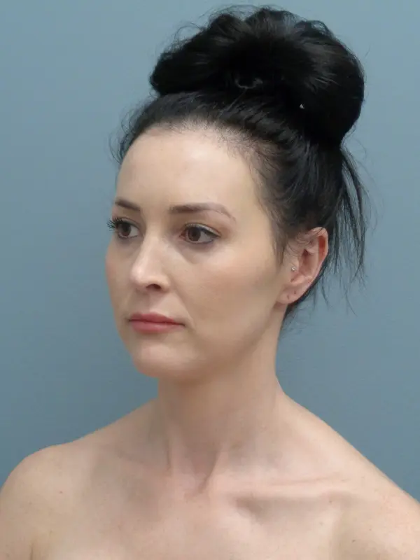 Otoplasty Before and After Pictures Nashville, TN
