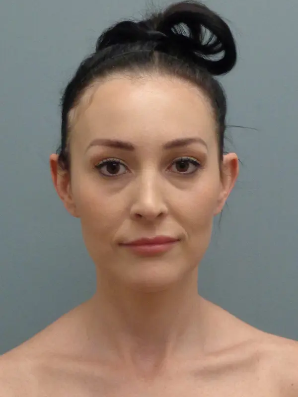 Otoplasty Before and After Pictures Nashville, TN