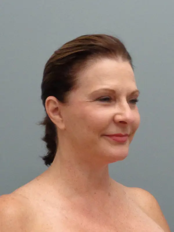 FACELIFT BEFORE & AFTER PICTURES IN NASHVILLE, TN