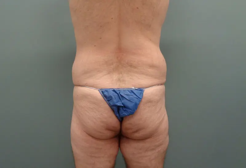 Body Lift Before and After Pictures Nashville, TN