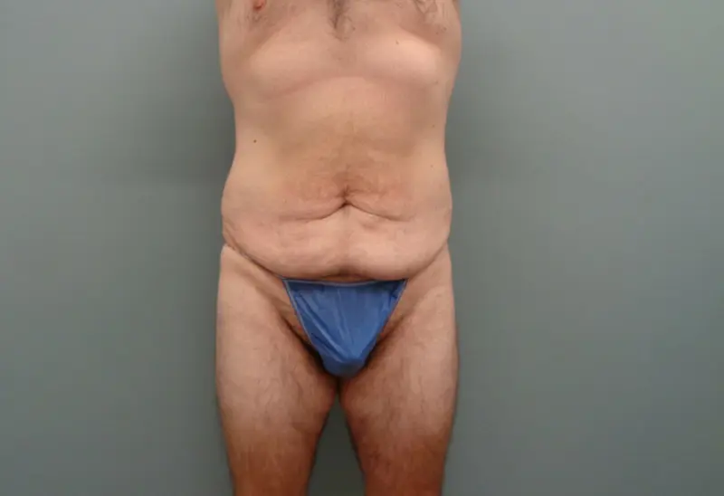Body Lift Before and After Pictures Nashville, TN