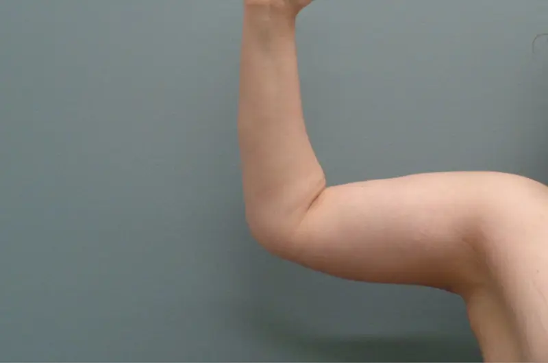 Arm Lift Before and After Pictures Nashville, TN