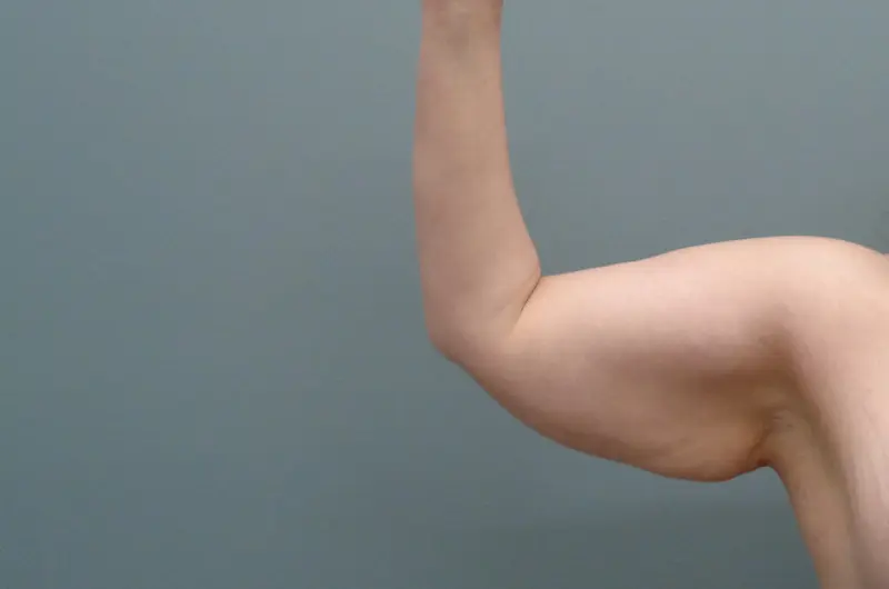 Arm Lift Before and After Pictures Nashville, TN