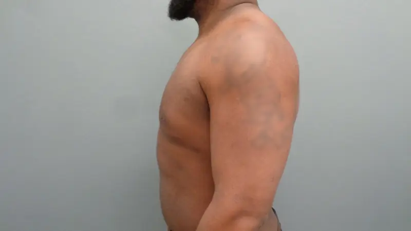 Gynecomastia Before & After Pictures in Nashville, TN