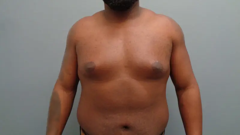 Gynecomastia Before & After Pictures in Nashville, TN