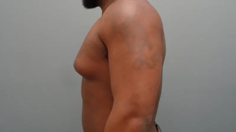 Gynecomastia Before & After Pictures in Nashville, TN