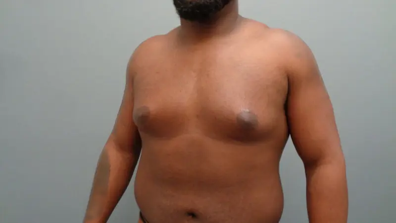 Gynecomastia Before & After Pictures in Nashville, TN