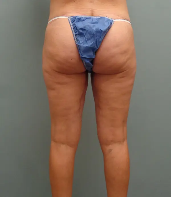 Thigh Lift Before and After Pictures Nashville, TN